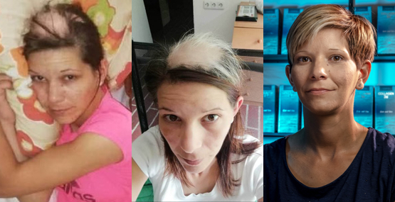 Real Life Story (with Video): I Lost 70% of My Hair but Collagen36 Saved Me  - Collagen36